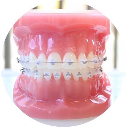 表側ワイヤー矯正