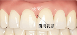 歯間乳頭