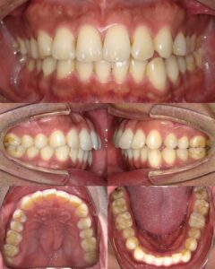 治療前の口腔内写真。上の前歯が前方に傾き、上下の前歯が噛み合っていない状態