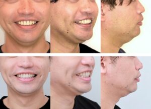 治療前後の顔写真 口元の突出感は変化がない